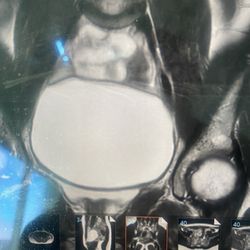 Spring Fertility - Big blob in the middle is the cyst covering all of my internal organs.