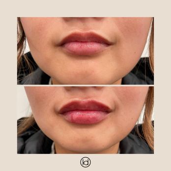 KD Aesthetics - Perfect Pout lip filler enhancement at KD Aesthetics in Bowling Green KY - Medical Spas Near Me - Bowling Green, Kentucky KD Aesthetics - Perfect Pout lip filler enhancement at KD Aesthetics in Bowling Green KY - Medical Spas Near Me - Bowling Green, Kentucky