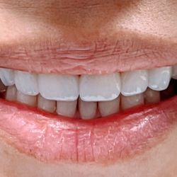 G Dental Group - After makeover made by Artisan laboratory technicians.