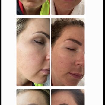 RC Holistic Hands Spa - After and Before VI Peel - Day Spas Near Me - Fort Lauderdale, Florida RC Holistic Hands Spa - After and Before VI Peel - Day Spas Near Me - Fort Lauderdale, Florida