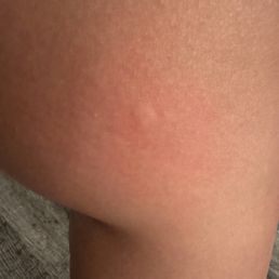 Bite