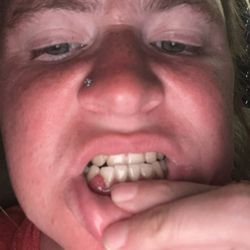 Harrisonburg Family Dentistry - It's very painful and I can't eat I just can eat ice cream