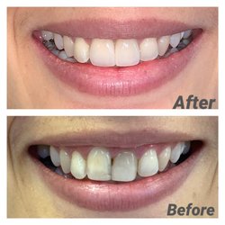 Orinda Dental Care - Cosmetic crowns!