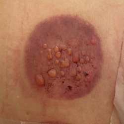 Kern David - Grace Health Center - Dr. David Kern, ND, Maui Hi *I Do Not Recommend! This is from his cupping, Second Degree Burns and Scarring!
