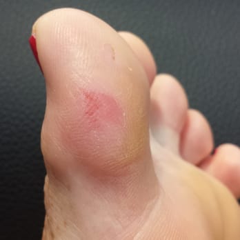 Nails Pro - My poor toe, just one portion of my foot that was razored raw by this horrific place. - Nail Salons Near Me - Columbus, Ohio Nails Pro - My poor toe, just one portion of my foot that was razored raw by this horrific place. - Nail Salons Near Me - Columbus, Ohio