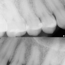 Lake Dental - Terrible fillings! Otoscopic X-ray shows moisture between fillings and tooth. Buyer Beware!