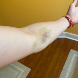 Stone Oak Urgent Care & Family Practice - Bruise two days after getting my blood drawn here.