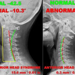 Spinal Correction Centers - Before and After 3 Months of Structural Correction of a Pediatric Patient with Resolution in Neck Pain and Headaches