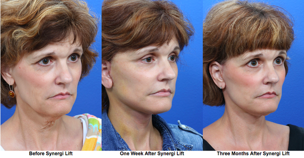 Synergi Facial Surgery