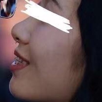 Lin Hu,DMD, DDS, MS, PhD - Flushing Advanced Orthodontics - 矫正中 - Orthodontists Near Me - Flushing, New York Lin Hu,DMD, DDS, MS, PhD - Flushing Advanced Orthodontics - 矫正中 - Orthodontists Near Me - Flushing, New York