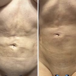 Waisted Body Bar - Before and after this was just 1 massage with the correct lymphatic massage