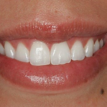 Rod W. Gore, DDS - After! Loved my results! - General Dentistry Near Me - Scottsdale, Arizona Rod W. Gore, DDS - After! Loved my results! - General Dentistry Near Me - Scottsdale, Arizona