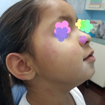 UMC Quick Care - She's itchy from head to toe from amoxicillin. - Urgent Care Near Me - Las Vegas, Nevada UMC Quick Care - She's itchy from head to toe from amoxicillin. - Urgent Care Near Me - Las Vegas, Nevada