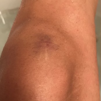 Automatic Slim's - Bruise from fall yesterday - New American Near Me - Memphis, Tennessee