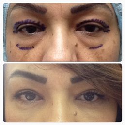 Upper and lower eye surgery. Dr. Hicks is the BEST!!! Upper and lower eye surgery. Dr. Hicks is the BEST!!!