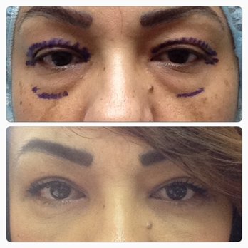 Pearlman D. Hicks Jr., M.D. - Upper and lower eye surgery. Dr. Hicks is the BEST!!! - Cosmetic Surgeons Near Me - Long Beach, California Pearlman D. Hicks Jr., M.D. - Upper and lower eye surgery. Dr. Hicks is the BEST!!! - Cosmetic Surgeons Near Me - Long Beach, California
