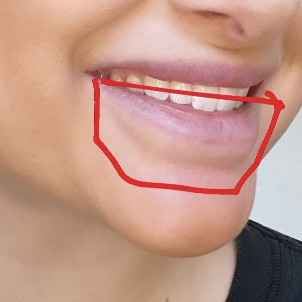 Steven K Struck, MD - Migrated filler - Cosmetic Surgeons Near Me - Atherton, California Steven K Struck, MD - Migrated filler - Cosmetic Surgeons Near Me - Atherton, California