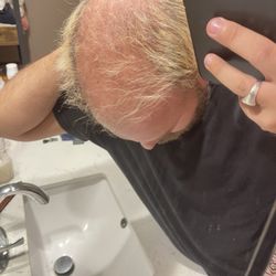 Best Hair Transplant