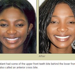 Seattle Dental Associates - Invisalign Results