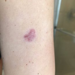 Horrible stitch job, infection, and terrible scar over something I later found out that was none threatening. Horrible stitch job, infection, and terrible scar over something I later found out that was none threatening.
