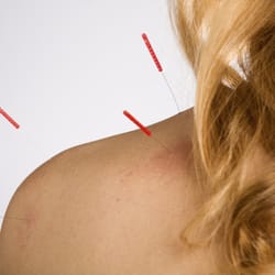 North Edmonton Wellness Centre - Acupuncture