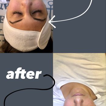 Elvina Skin - Before & After HydroDermabrasion Facial - Skin Care Near Me - Glendale, California