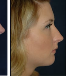 Theodore Staahl, MD - Center For Cosmetic Surgery - Rhinoplasty for nasal refinement and chin implant for better facial balance.