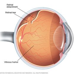 Retinal Detachment & Tear