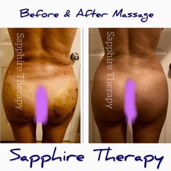 Sapphire Therapy Miami - Amazing results after post surgical lymphatic drainage massage at Sapphire Therapy. We do mobile massage. Free consultation. - Massage Therapy Near Me - Miami, Florida Sapphire Therapy Miami - Amazing results after post surgical lymphatic drainage massage at Sapphire Therapy. We do mobile massage. Free consultation. - Massage Therapy Near Me - Miami, Florida