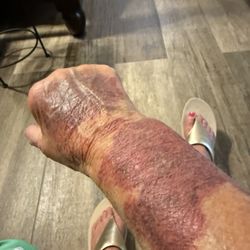 Baylor Charles A Sammons Cancer Center - This is my hand/arm after a "nurse" tried to put an IV in for iron infusion. Not happy!