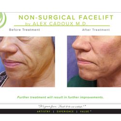 Cadoux Botox Center - Stunning Non-Surgical Face Lift by Dr.Cadoux. Results are gradual, natural and long-lasting.