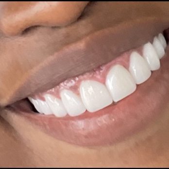 Cupertino Facial Esthetics - Ten porcelain vaneers with gum lift. - Cosmetic Dentists Near Me - Cupertino, California Cupertino Facial Esthetics - Ten porcelain vaneers with gum lift. - Cosmetic Dentists Near Me - Cupertino, California