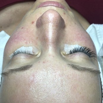 Muse Jennifer Spa - Dramatic difference before and after! - Day Spas Near Me - Lake Hiawatha, New Jersey Muse Jennifer Spa - Dramatic difference before and after! - Day Spas Near Me - Lake Hiawatha, New Jersey