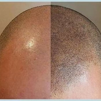 Micromi Brows - Scalp micro pigmentation - Permanent Makeup Near Me - Decatur, Georgia Micromi Brows - Scalp micro pigmentation - Permanent Makeup Near Me - Decatur, Georgia