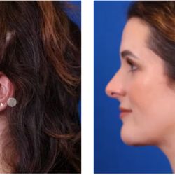 John Harbison - Minimally invasive Neck lift