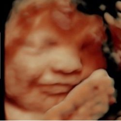 Miracle View 3D/4D Ultrasound