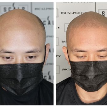 Scalp Society - Quick tip: tan your head before going in - Hair Loss Centers Near Me - San Jose, California