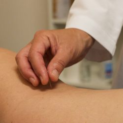 Tampa Heights Acupuncture - Acupuncture needle manipulation