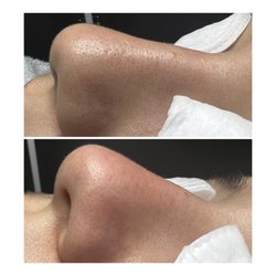 Total vanity esthetics - Limpieza profunda