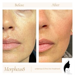 HD Aesthetic Wellness - Morpheus8 under eyes