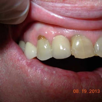 Gentle Dentistry - Permanent crown 8 months later - General Dentistry Near Me - Modesto, California