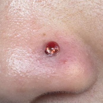 Nebu Piercings - Right after Priscilla tried removing the piercing. - Piercing Near Me - Pacifica, California Nebu Piercings - Right after Priscilla tried removing the piercing. - Piercing Near Me - Pacifica, California