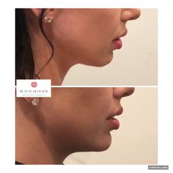 Beauty Religion - Before and after #Chinfiller