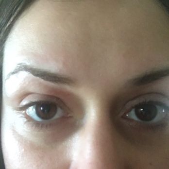 Diamond Nail Beauty Salon - Day 2: swelling over both eyes, mostly right eye - Hair Salons Near Me - Hamilton, Ontario Diamond Nail Beauty Salon - Day 2: swelling over both eyes, mostly right eye - Hair Salons Near Me - Hamilton, Ontario