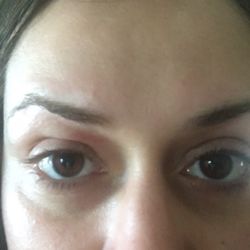 Diamond Nail Beauty Salon - Day 2: swelling over both eyes, mostly right eye