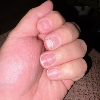 Sala Nails & Spa - thinned out nails that the acrylic caused a big slit on my nail where it's barely hanging on - Waxing Near Me - Aurora, Colorado Sala Nails & Spa - thinned out nails that the acrylic caused a big slit on my nail where it's barely hanging on - Waxing Near Me - Aurora, Colorado