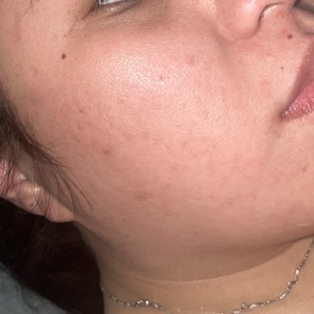Daisy MD Care - My skin 3 months later - Acne Treatment Near Me - Santa Ana, California Daisy MD Care - My skin 3 months later - Acne Treatment Near Me - Santa Ana, California