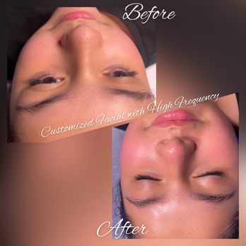 Be Esthetics Beauty - Customized Teenage Facial w/High Frequency - Skin Care Near Me - Phoenix, Arizona
