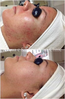 AES Acne Clinic by null