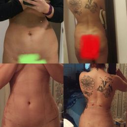 My before and after results of vaser lipo on my waist and hips. My before and after results of vaser lipo on my waist and hips.